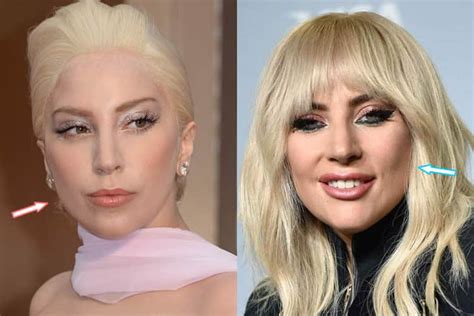 lady gaga surgery|Lady Gaga’s new look sparks plastic surgery debate